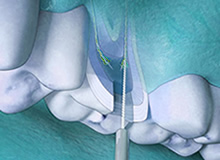 endodonzia